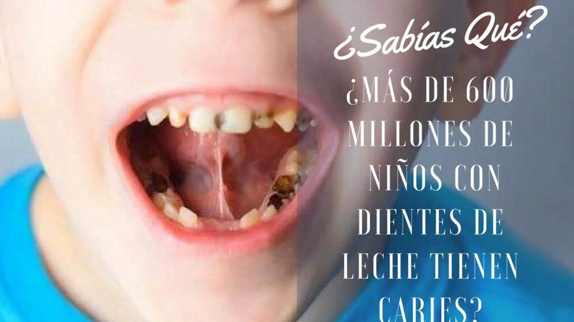 Dientes de leche con caries